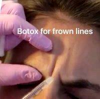 Botox For Frown Lines