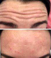 Botox Forehead Lines Before And After