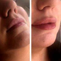 Botox Injections For Lips Before And After
