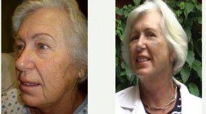 Complete Facelift - Woman 62 Years Young - 10 Days Post-Op With Doctor Guillermo Koelliker, MD, Mexico Plastic Surgeon