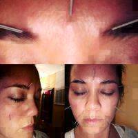 Cosmetic Acupuncture Facial Treatment
