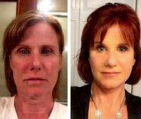 Cosmetic Face Lift With Dr Kyle S. Choe Before And After