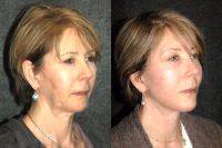 Deep Plane Facelift Before And After