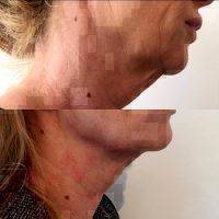 Different Types Of Facelift Surgery