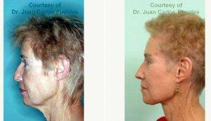 Doctor Juan Carlos Fuentes, MD, Mexico Plastic Surgeon - 58 Year Old Woman Treated With Facelift