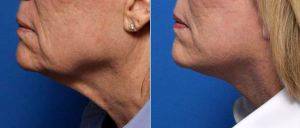 Doctor Kian Karimi, MD, FACS, Los Angeles Facial Plastic Surgeon - Game Changing Results With Face And Neck Lift Procedure Goodbye Jowls, Goodbye Turkey Neck