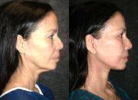 Dr Jacono Facelift Photos Before And After