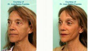 Dr Juan Carlos Fuentes, MD, Mexico Plastic Surgeon - 62 Year Old Woman Treated With Facelift