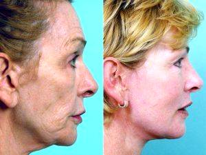Dr. Alejandro J. Quiroz, MD, FACS, Mexico Plastic Surgeon - Patient Had A Face Lift, 3 Sessions Of Fraxel Thermage