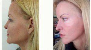 Dr. Marco Carmona, MD, Mexico Plastic Surgeon - 53 Year Old Woman Treated With Facelift