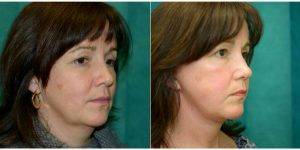 Dr. Paul A. Wilson, FRCS(Plast), Bristol Plastic Surgeon - 51 Year Old Woman Treated With Facelift