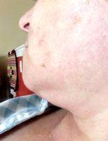 Excess Fatty Deposits Under The Chin