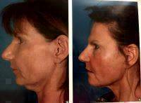 Face Lift With Neck Lift Photo