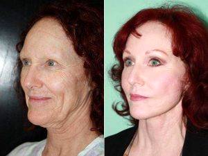 Facelift By Dr. Alejandro J. Quiroz, MD, FACS, Mexico Plastic Surgeon