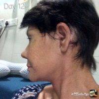 Facelift Day 12