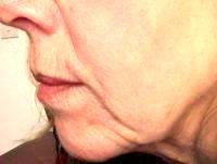 Facelift For 40 Year Old