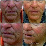 Facelift For Man Before And After