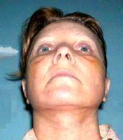 Facelift Incisions Usually Begin Above The Hairline At The Temple