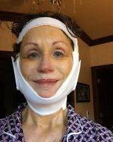Facelift Recovery - Getting Back To Normal