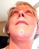 Facelifts Can Be Combined With Other Surgical Procedures