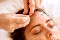Facial Acupuncture Procedure