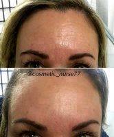 Forehead Botox Pictures