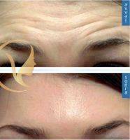 Forehead Lines Botox Before And After