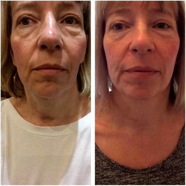 39++ Hifu vorher nachher bilder , HIFU Before And After Pics (2) » Facelift Info, Prices, Photos
