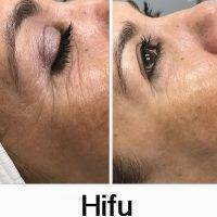 HIFU Face Tightening Before And After