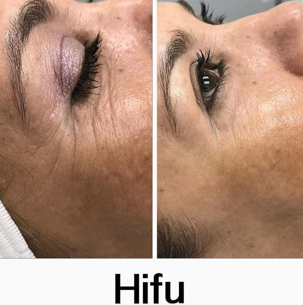 Hifu Face Tightening Before And After Facelift Info Prices Photos Reviews Qanda