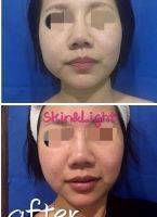 HIFU Facelift Before And After (3)