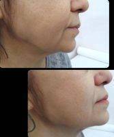 HIFU Facelift Before And After (4)