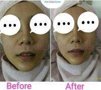 HIFU Facial Before And After (5)