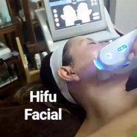 HIFU For Face Before And After (13)