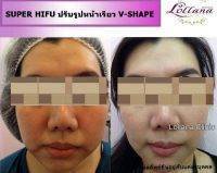 HIFU For Face Before And After (2)