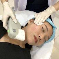 HIFU Non-Surgical Face Lift Before And After (3)
