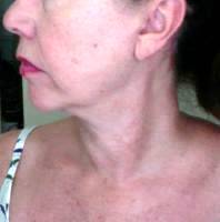 How Can I Reduce My Jowls