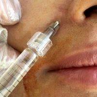 How Much Botox Facelift Costs