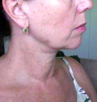 How To Fix Sagging Jowls Without Surgery