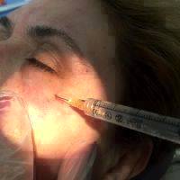 Injectable Fillers For Wrinkles