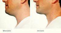 Kybella For Jowls Before And After