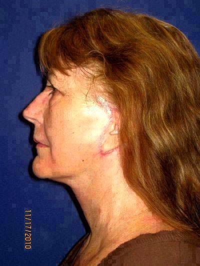 Lifestyle Lift For Neck » Facelift: Info, Prices, Photos ...