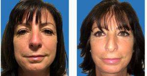 Lift And Fill Facelift Before And After With Dr. William Townley, MD, FRCS(Plast), London Plastic Surgeon