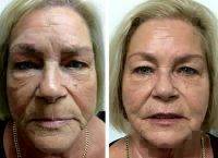 Liquid Facelift Uk Before And After