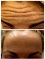 Liquid Forehead Lift Before And After