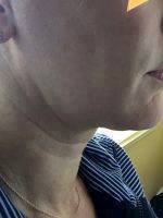 Loose Skin And Fat Under The Chin And Jaw