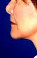 Lower Face And Neck Lift Pictures (1)