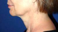 Lower Face And Neck Lift Pictures (14)