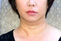 Lower Face And Neck Lift Pictures (31)