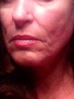 Lower Face And Neck Lift Pictures (5)